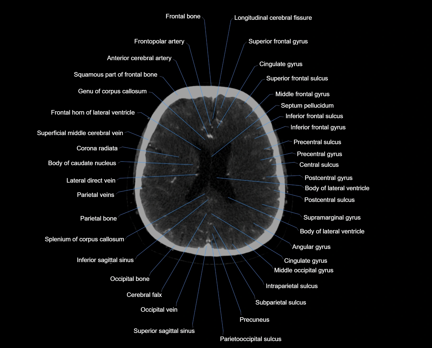 CT scan brain axial labelled cross sectional anatomy image-img-000045.webp